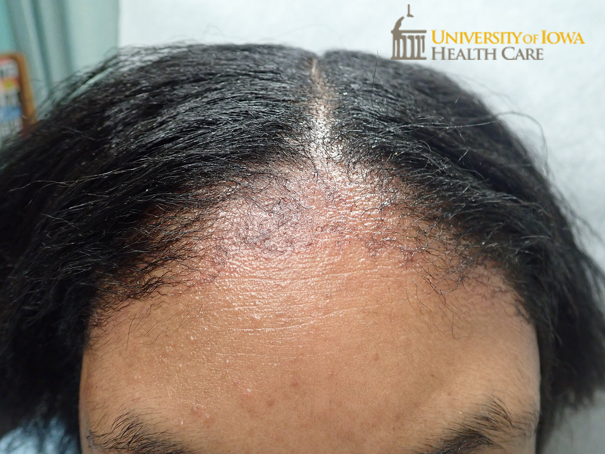 Erythematous papules with surrounding erythema on the frontal scalp. (click images for higher resolution).